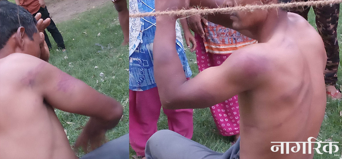 प्रहरीको कुटाइबाट कोरोना संक्रमित युवकको हात भाँचियो
